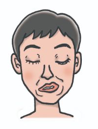 FSHD患者さんの顔貌